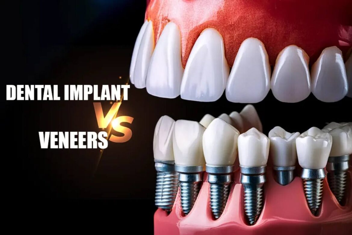 Dental Implants vs. Veneers