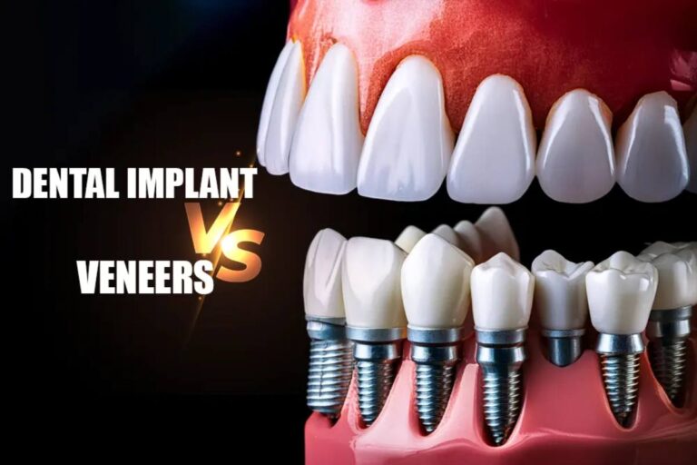 Dental Implants vs. Veneers