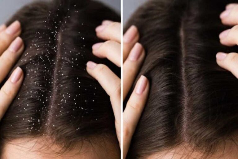 dandruff treatment at home