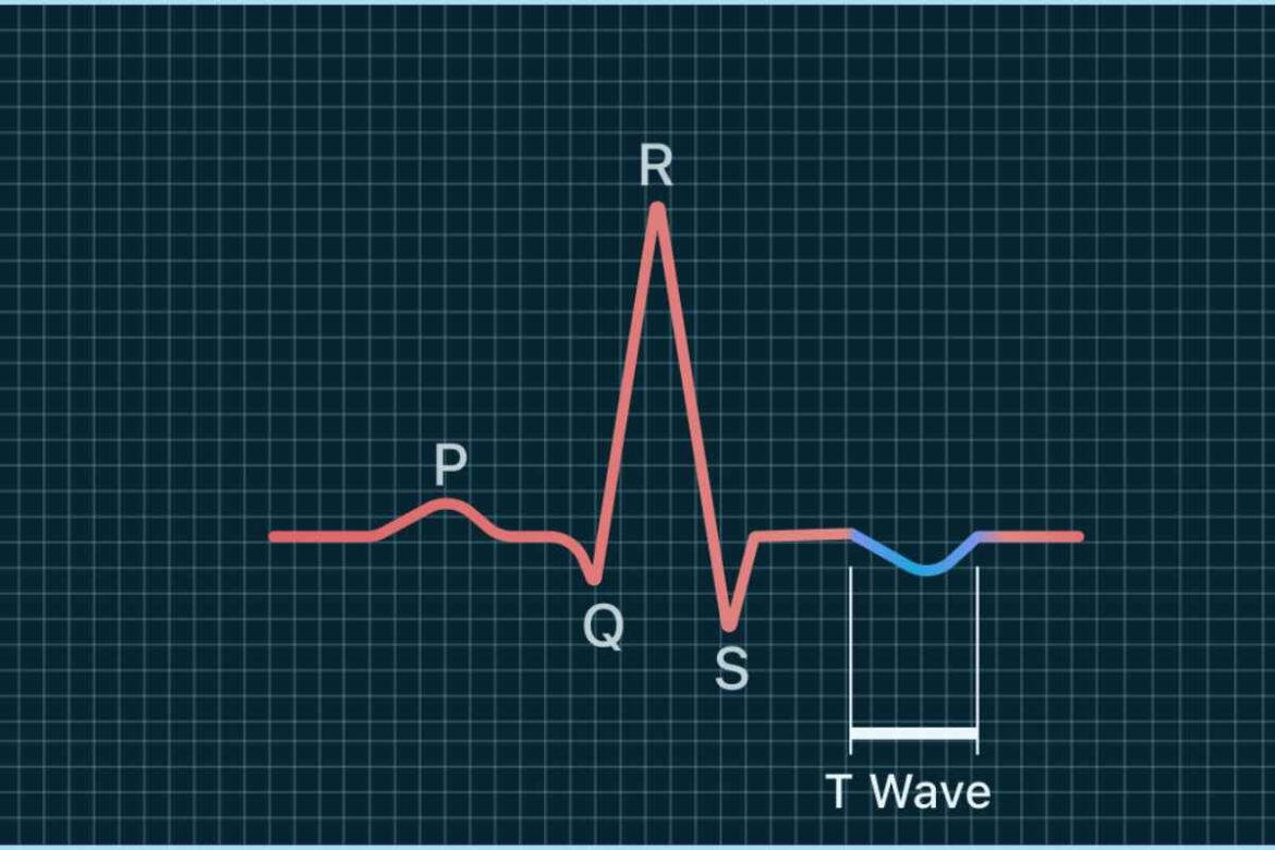 abnormal t wave